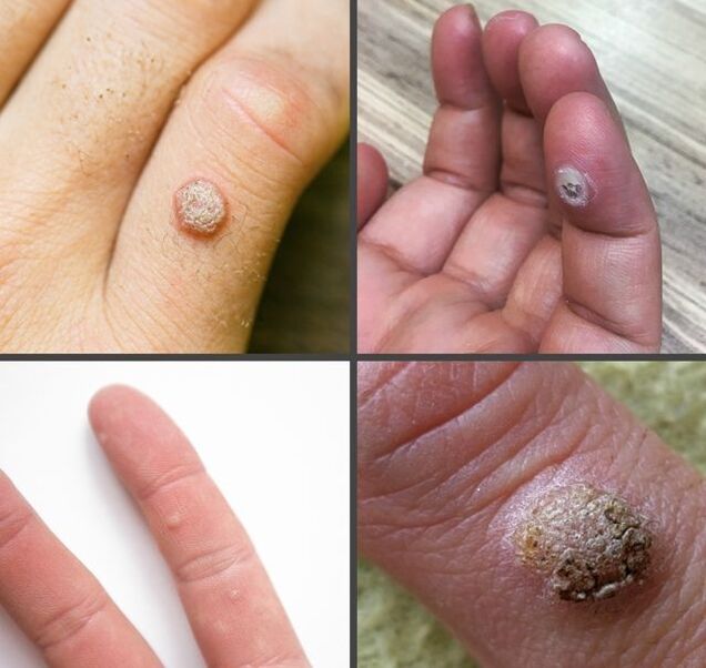 Types courants de verrues sur les doigts